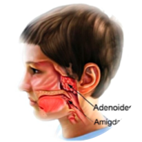 adenoide quadro.png