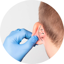 otoplastia quadro.png