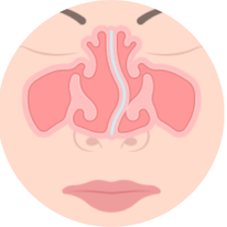 septoplastia quadro.png